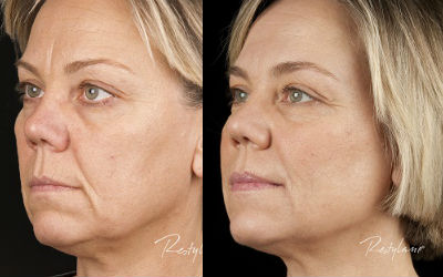 Fillers For Jowls Before And After